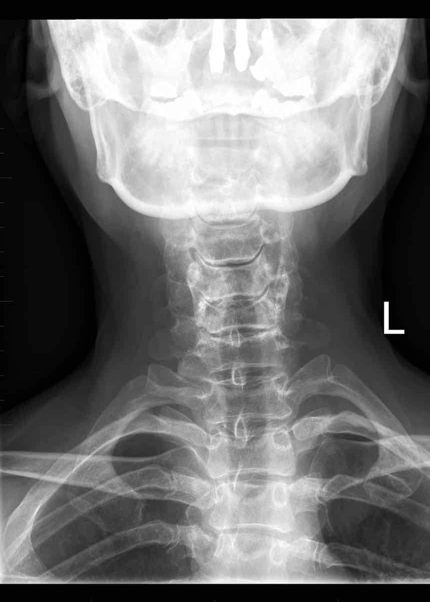 Frontal (anteroposterior) radiograph of the cervical spine demonstrating mild degeneration of the uncovertebral joints.