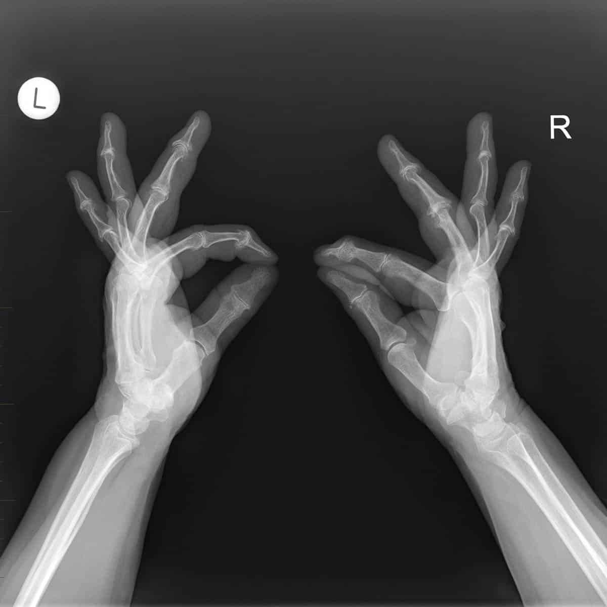 Thumb pinch radiographs as part of assessing a patient for arthritis.