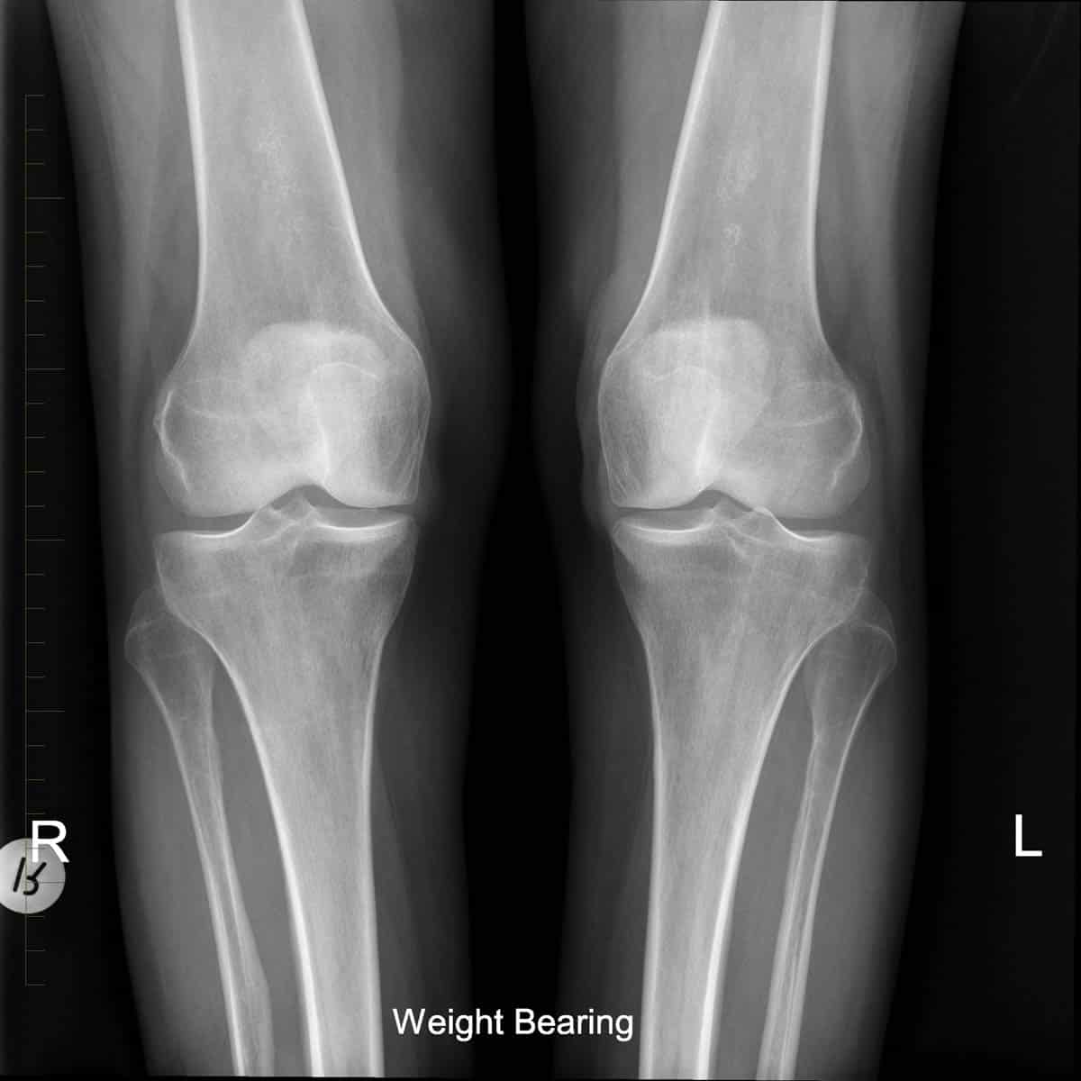 Digital X-Ray of 2 Knees - Melbourne Radiology Clinic