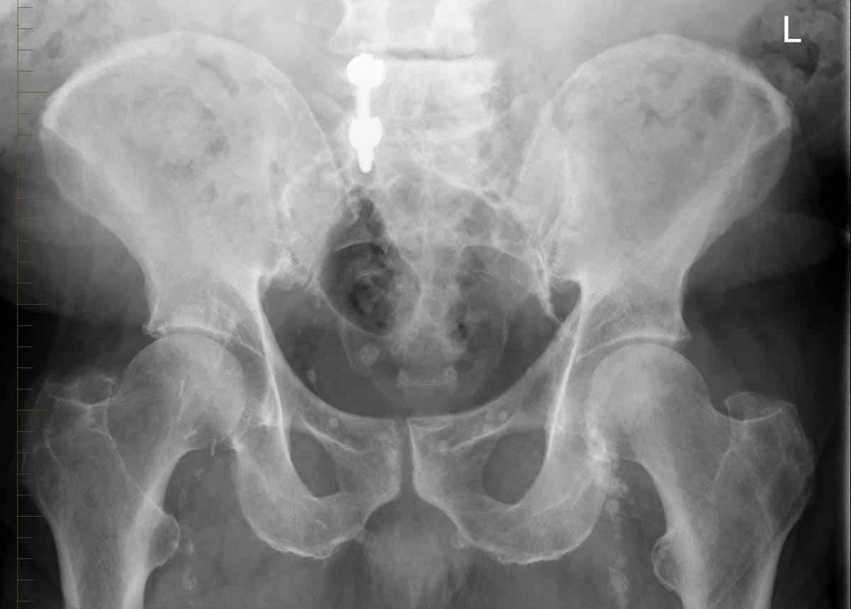 Frontal (anteroposterior) radiograph of the pelvis demonstrating mild bilateral hip osteoarthritis and previous surgery to the right lower lumbar spine.