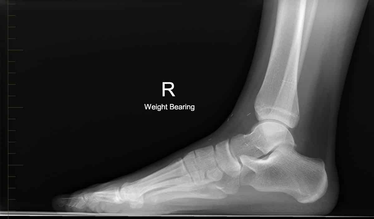 x-ray of a foot with the words weight bearing