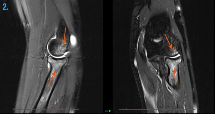 scanning of an elbow with bone bruising