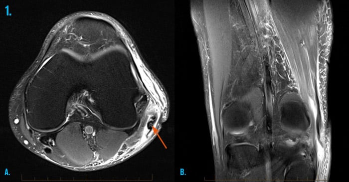 MRI of a biceps femoris