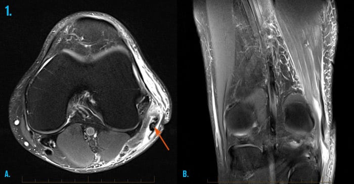 Hamstring And Groin Injuries Melbourne Sports Imaging