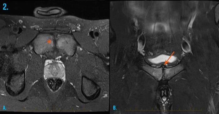 hamstring-groin-2-oseitis-pubis MRI of oseitis pubis