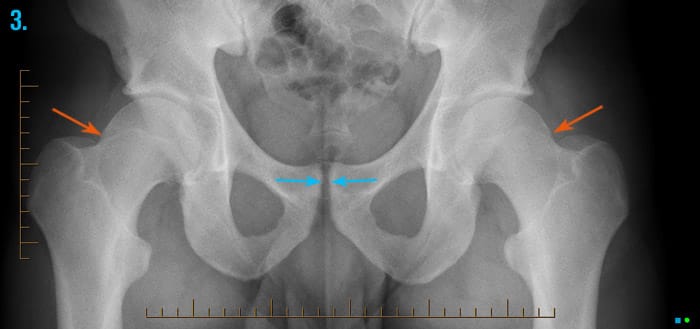 x-ray of the hip