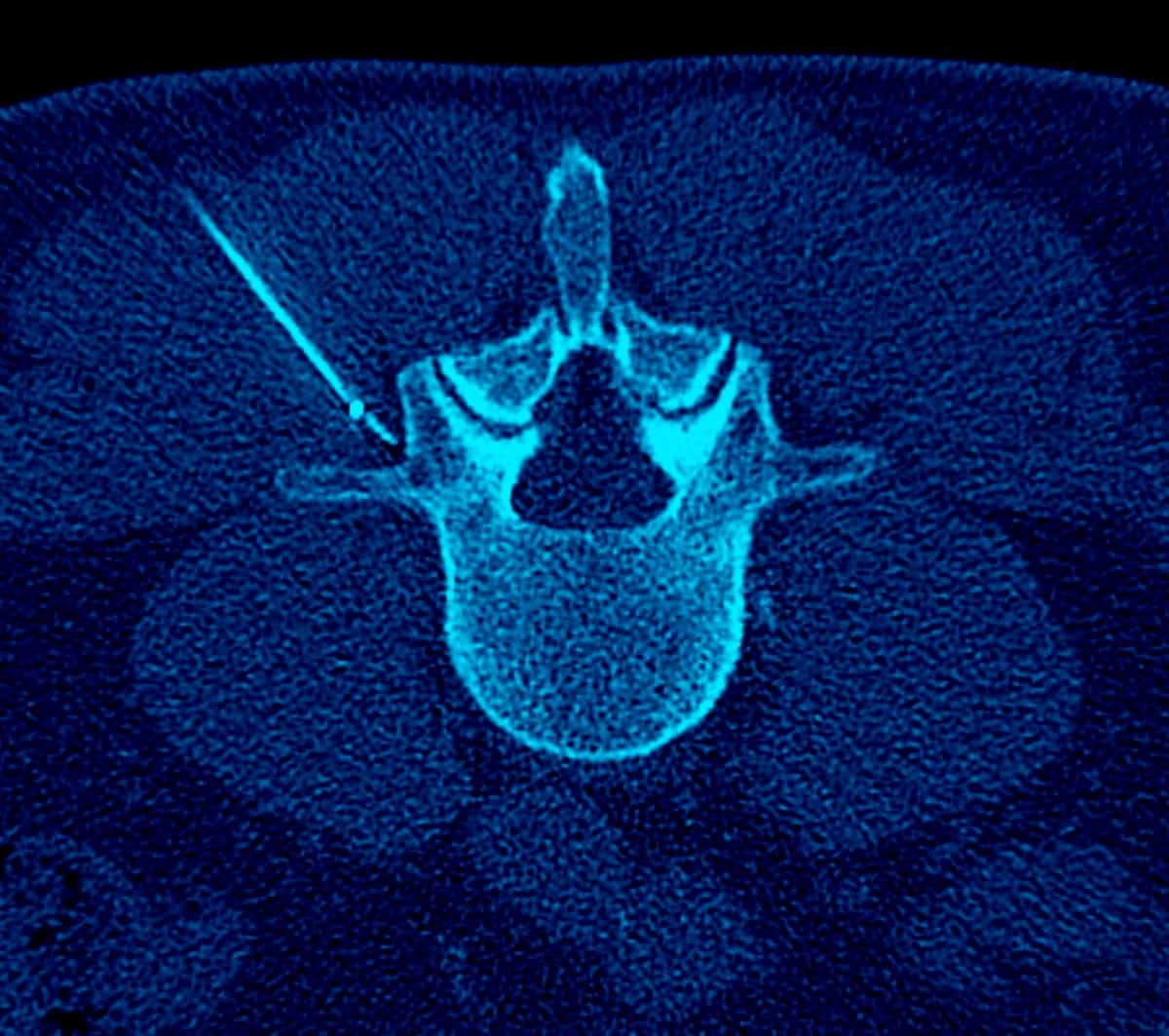 CT scan of a back pain injection