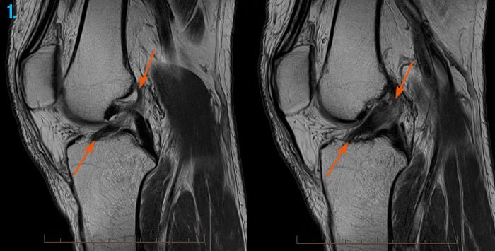 MRI of the knee with ACL tear