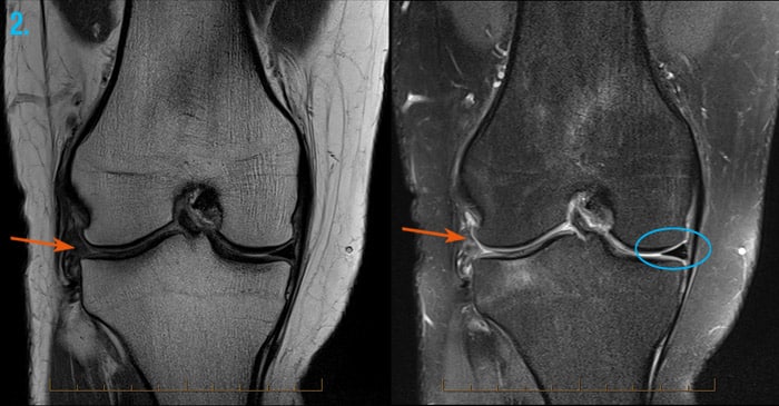 MRI images of a knee with lateral meniscus tear