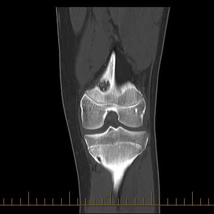 scan image of a knee