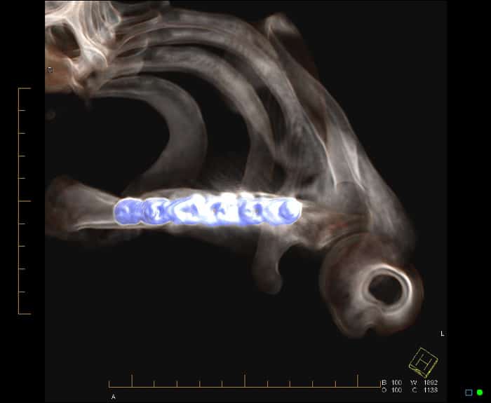 CT scan of a clavicle