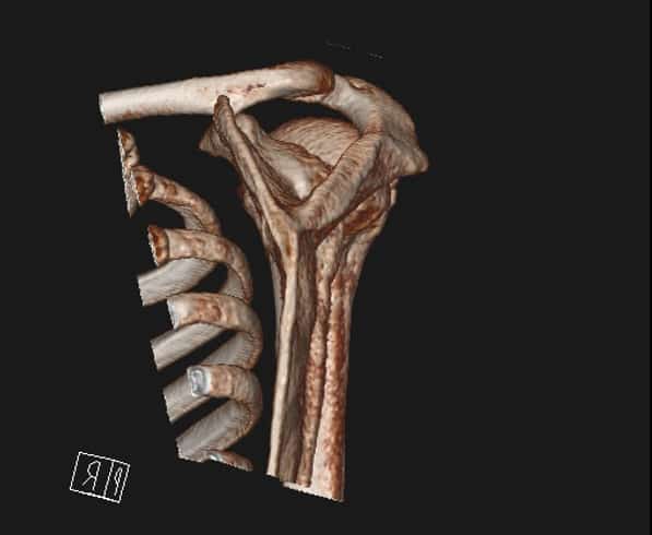 CT scan of a shoulder