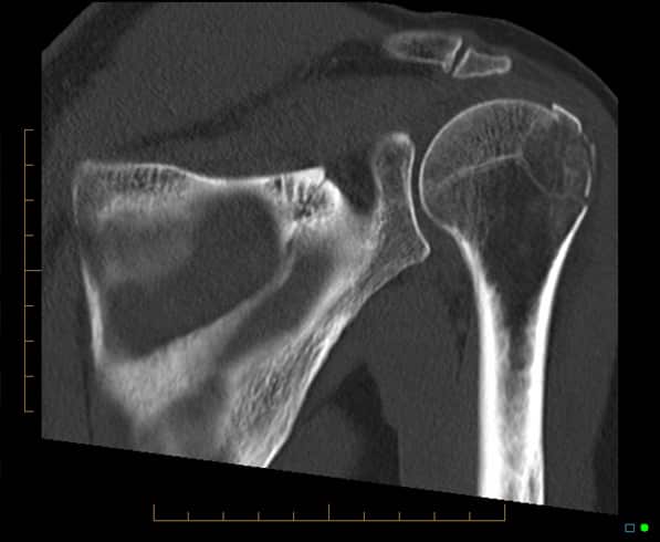CT scan of a shoulder
