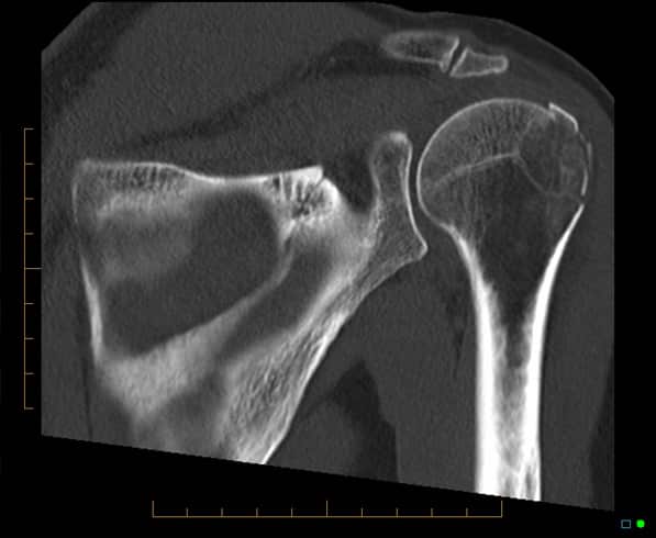 AC Joint Subluxation Radiology Melbourne