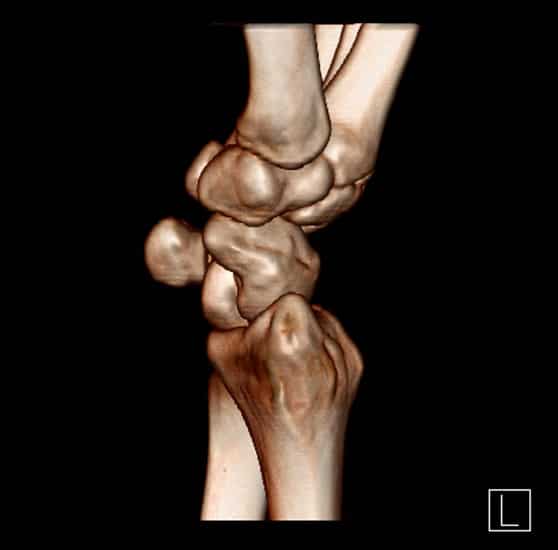 CT scan of a wrist left side