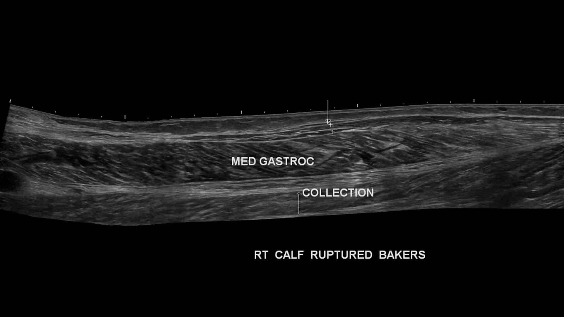 Ultrasound examination of the calf demonstrates fluid within the subcutaneous tissues due to a ruptured Baker’s cyst (arrow).