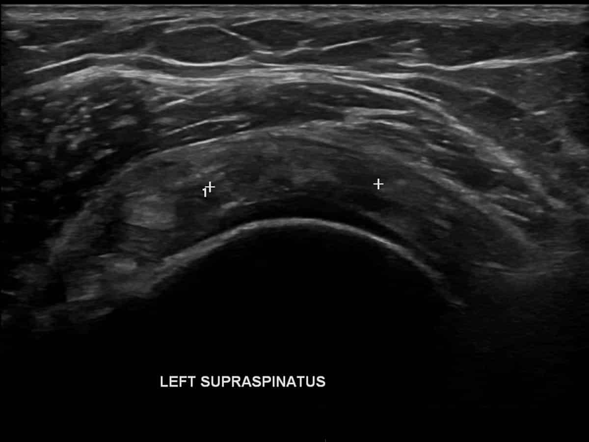 Short axis view of the left shoulder demonstrates an irregular full thickness tear of the supraspinatus tendon (calipers).