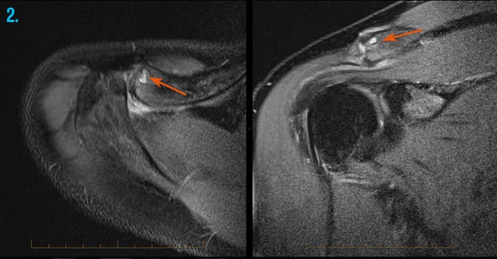 MRI of shoulder joint