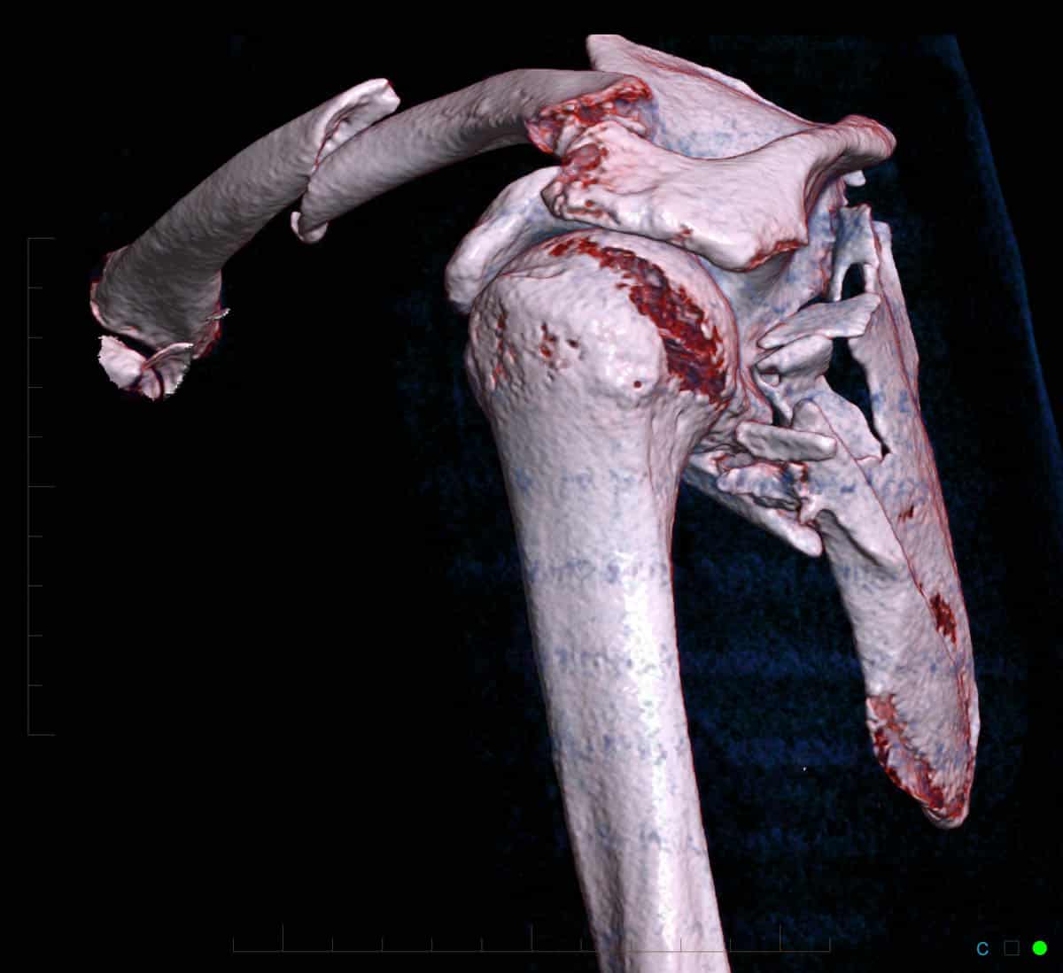 3. CT clavicle and scapula blade fracture with the source image (1) showing the clavicle fracture and the 3D images (2 & 3) showing the clavicle and the shoulder blade fracture