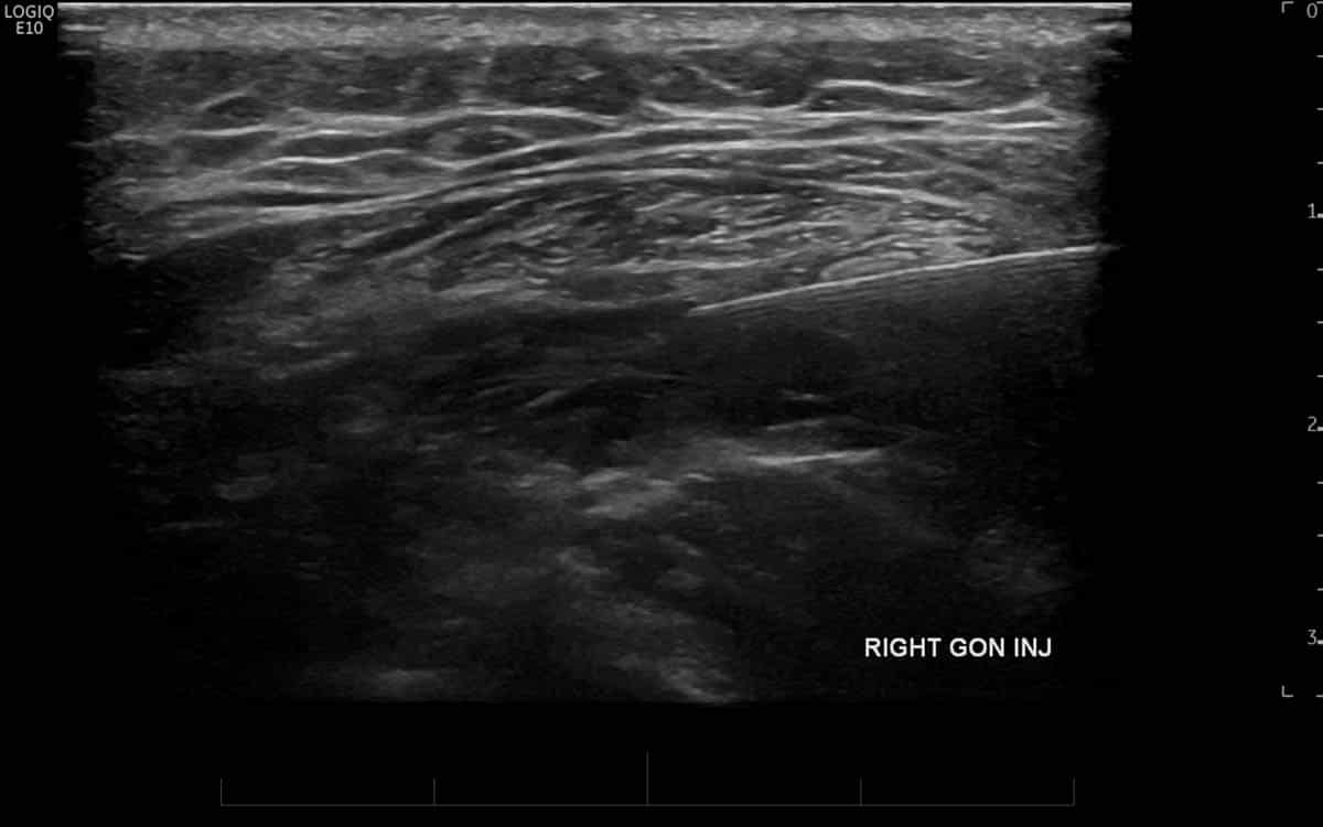Ultrasound guided injection of the greater occipital nerve