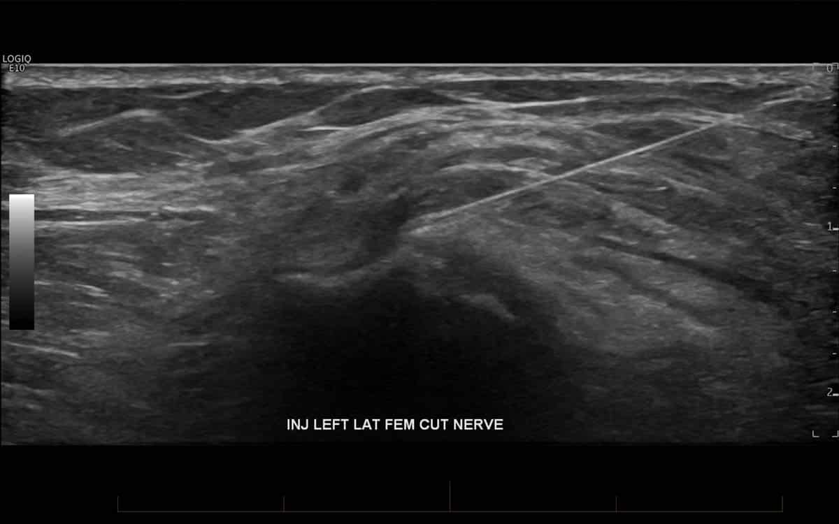 Ultrasound guided left lateral femoral cutaneous nerve injection for the treatment of meralgia paraesthetica.