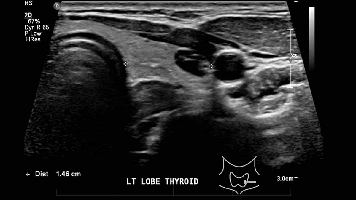 Short axis views of the left lobe of the thyroid gland demonstrates as small colloid nodule (arrow).