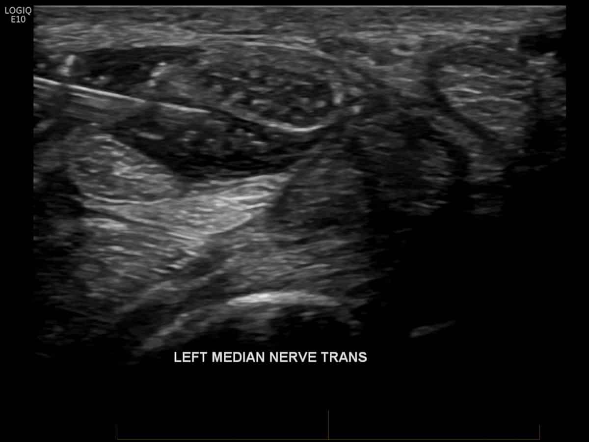 ultrasound of a left median nerve injection