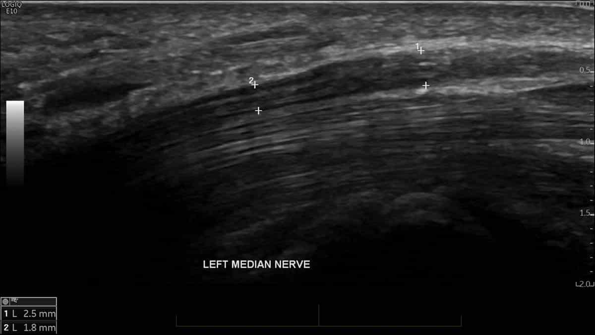 Longitudinal ultrasound of the median nerve demonstrates thinning of the nerve at the level of the carpal tunnel, supporting the clinical diagnosis of carpal tunnel syndrome.