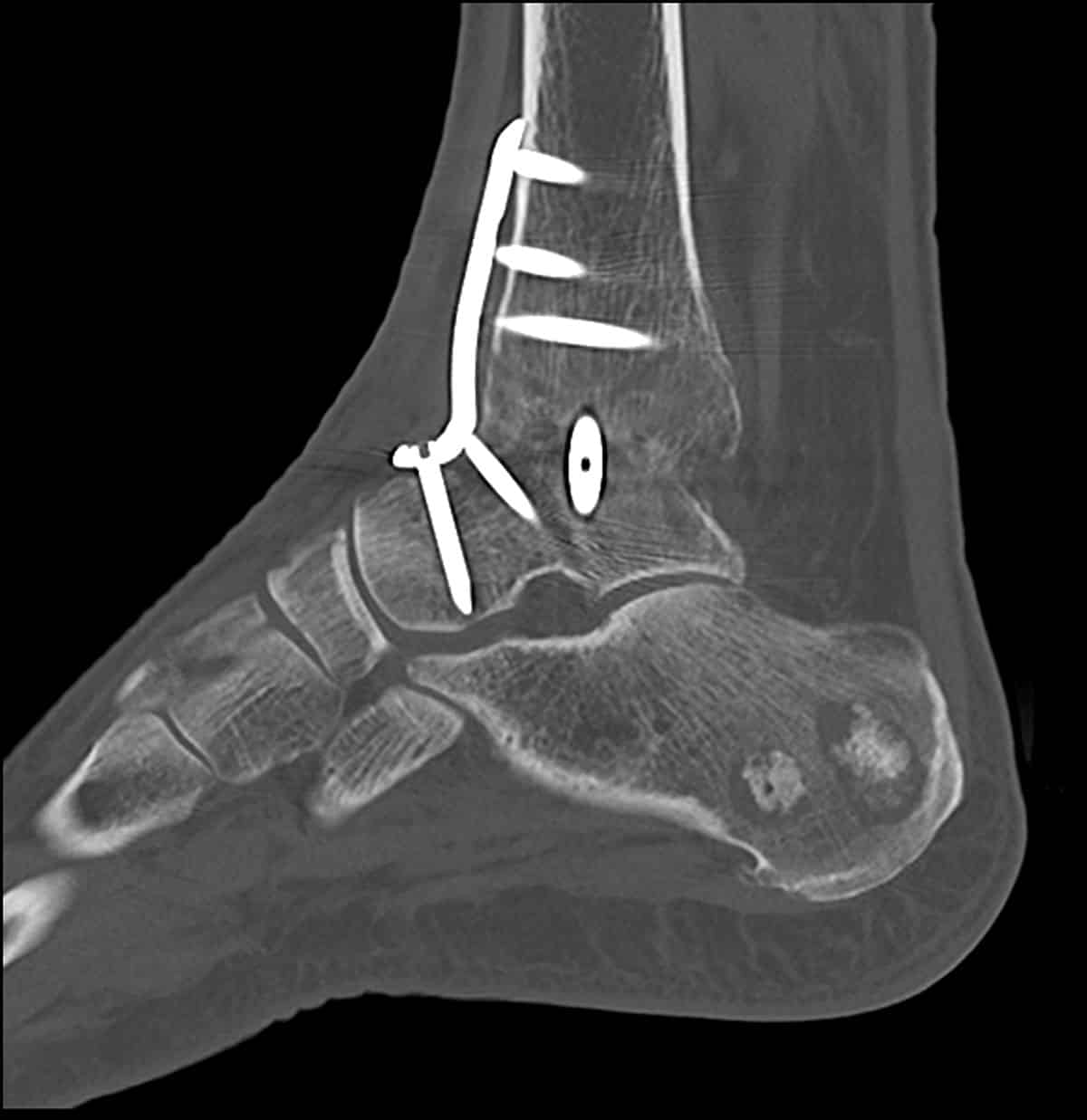 CT scan of an ankle