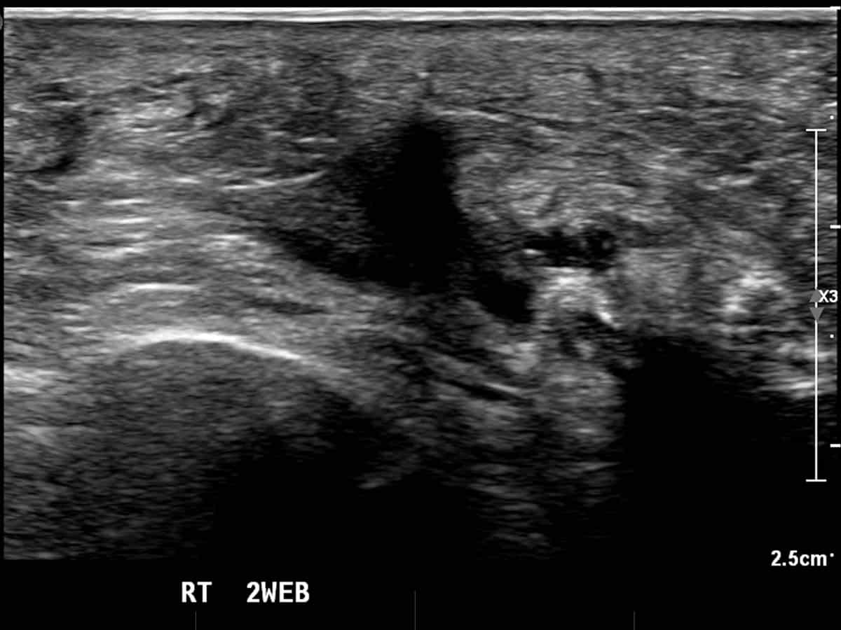 ultrasound guided injection for Morton's neuroma treatment