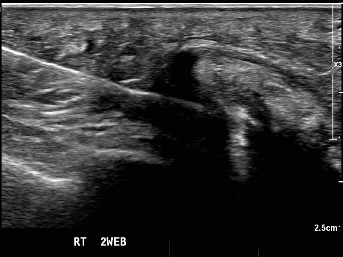 ultrasound guided injection for Morton's neuroma