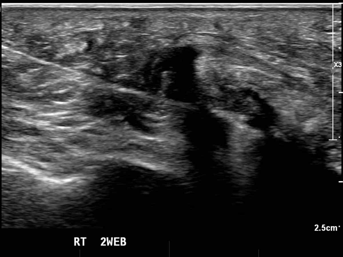 Ultrasound of an injection procedure to treat Morton's neuroma