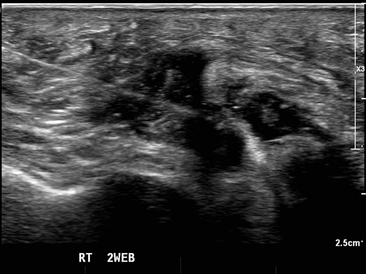 ultrasound guided injection to treat Morton's neuroma