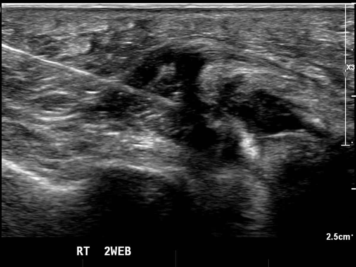 ultrasound of Mortons Neuroma injection