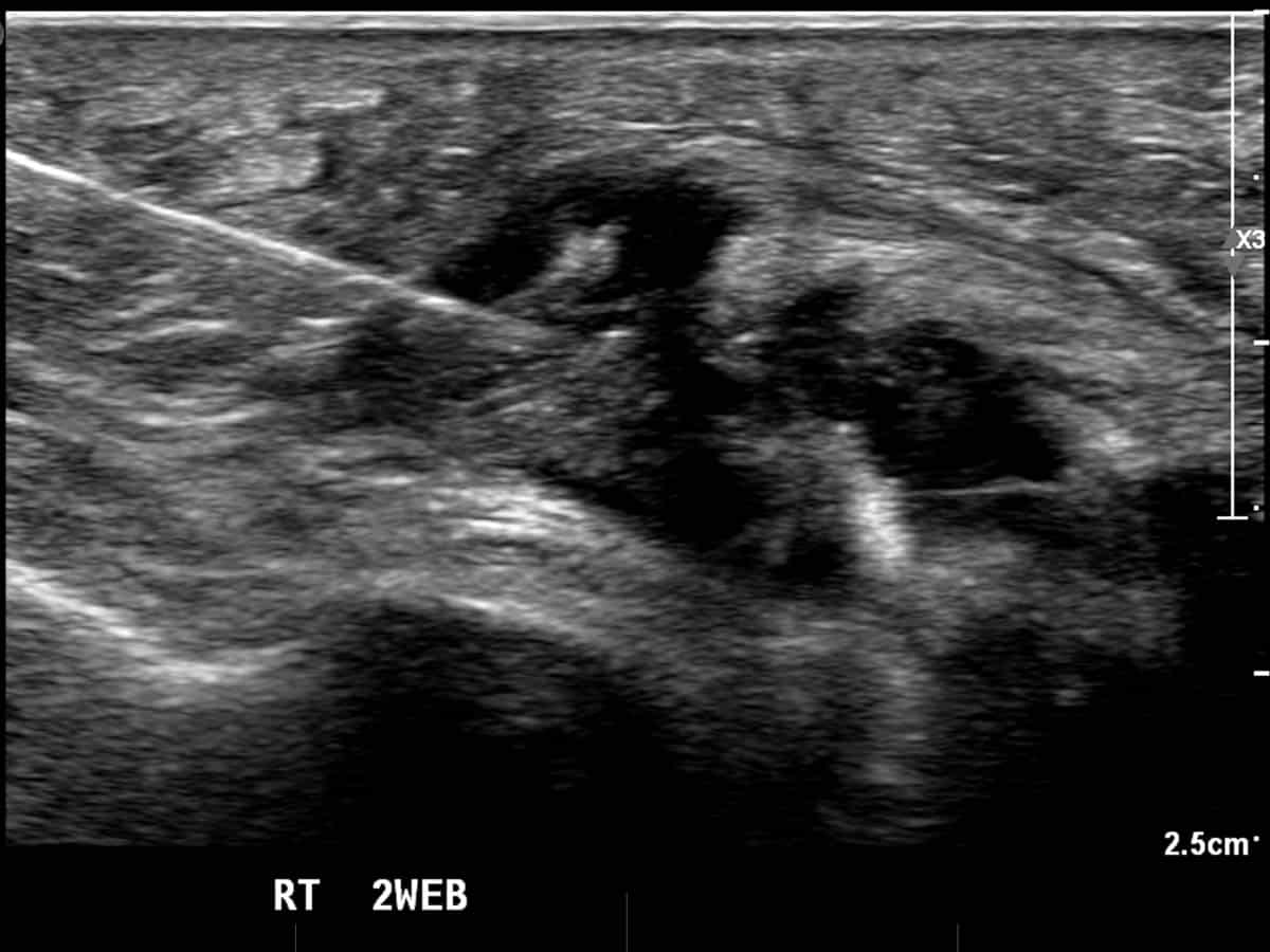 ultrasound guided injection to treat Morton's neuroma