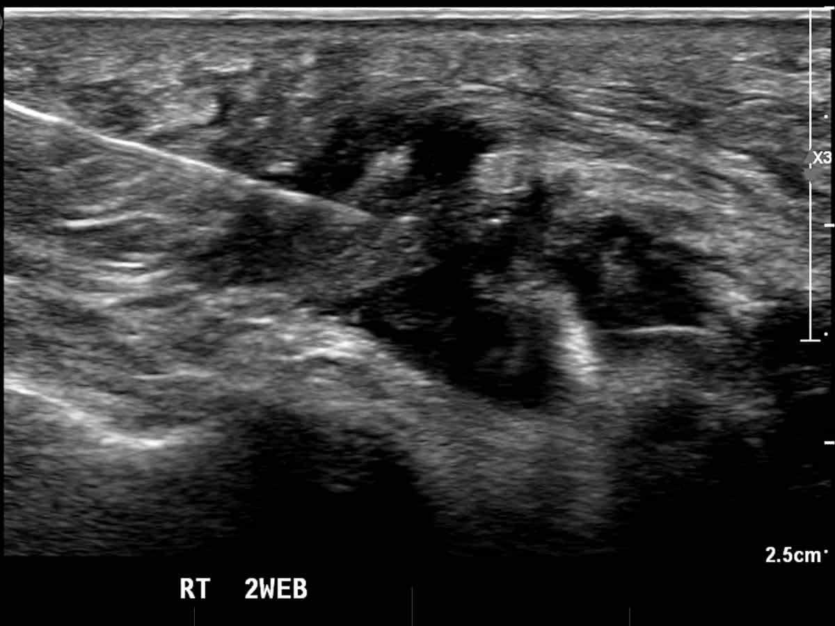 ultrasound guided inject to treat Morton's neuroma