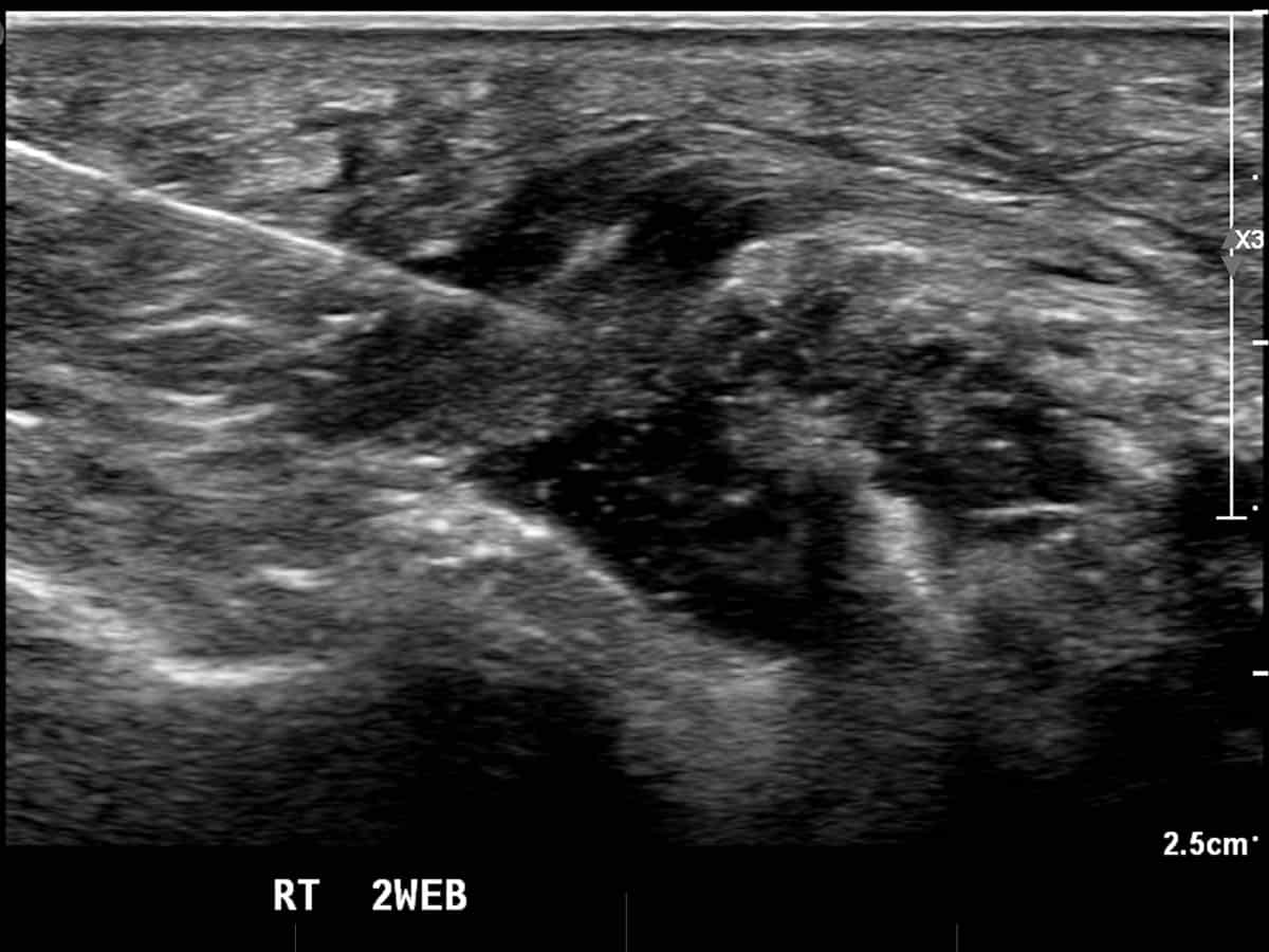 ultrasound of a Morton's neuroma injection
