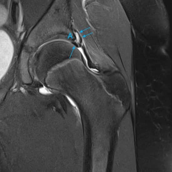 MRI scan of a hip subluxation
