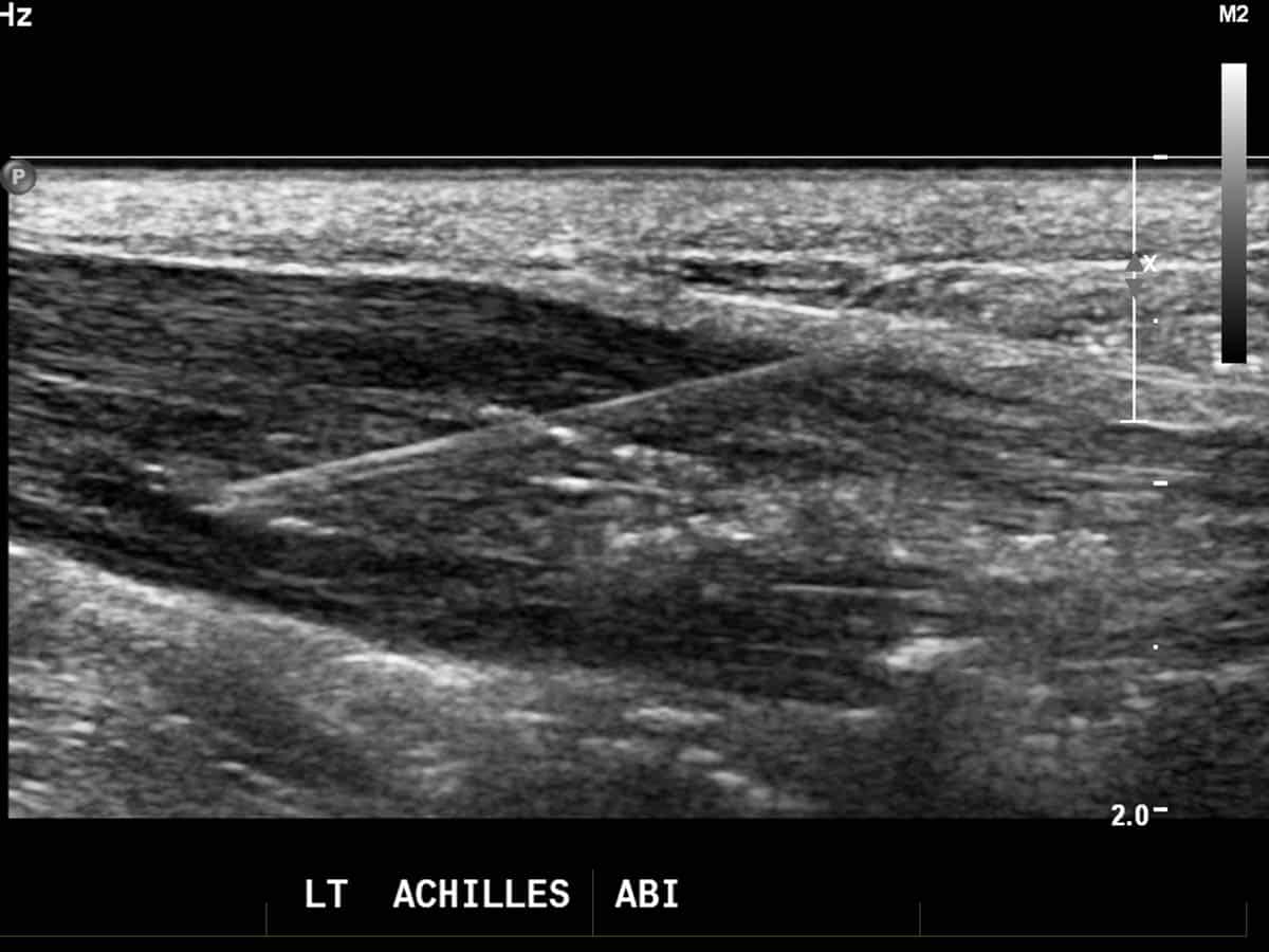 Autologous blood injection (ABI) - left Achilles tendon