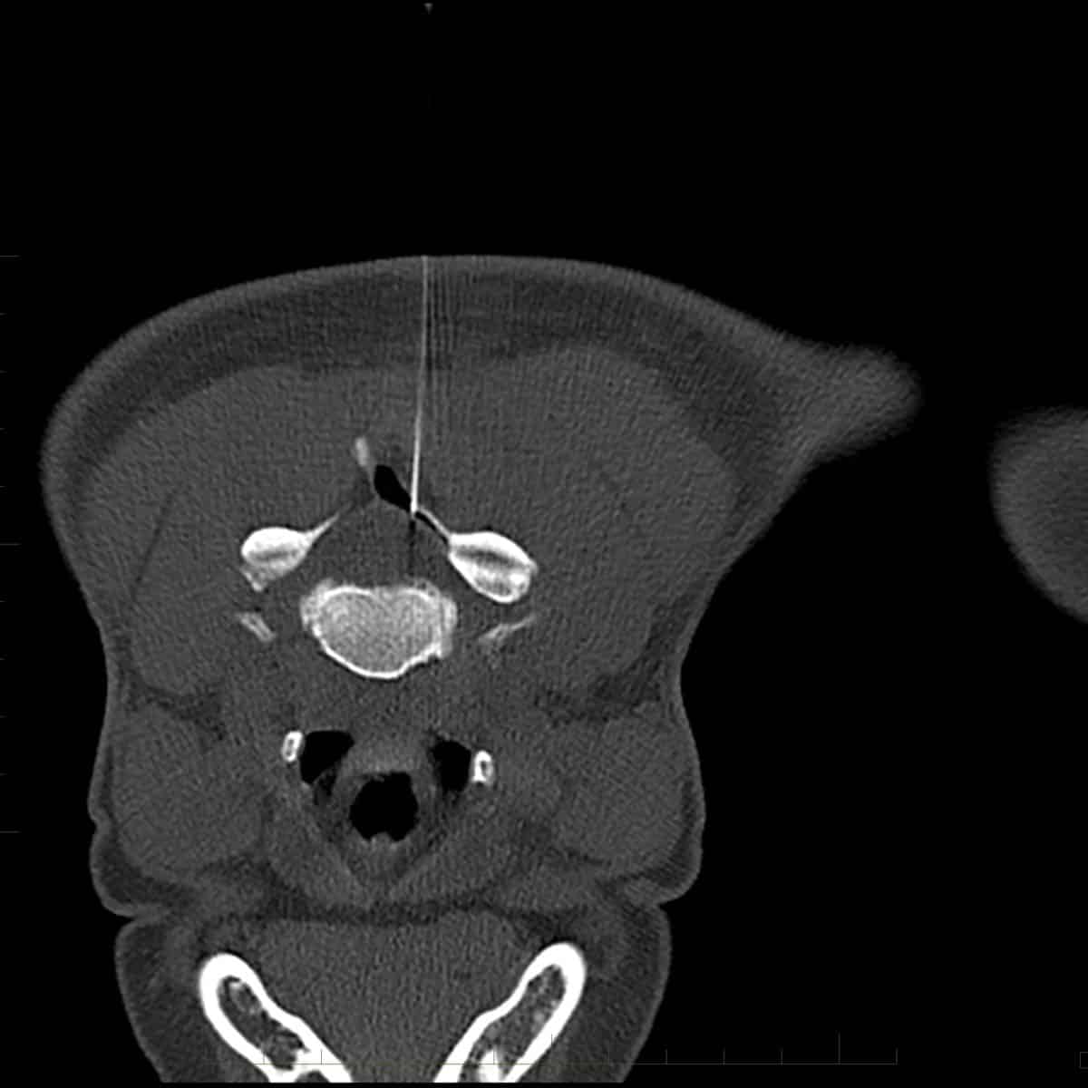 CT scan of a cervical epidural injection
