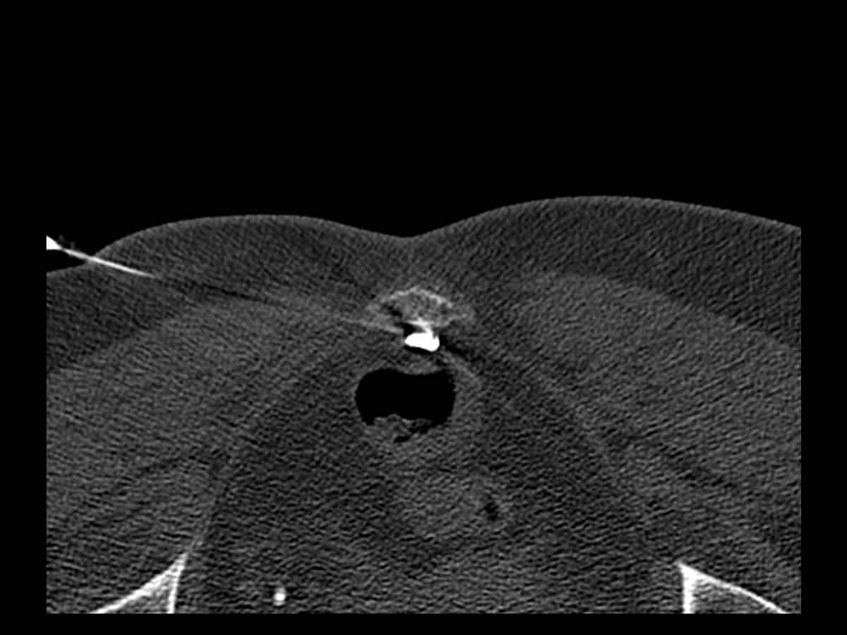 CT guided ganglion impar block with local anaesthetic with cortisone