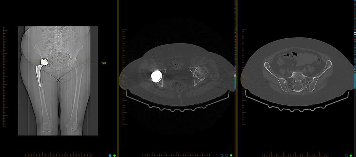 CT scan pre operative templating