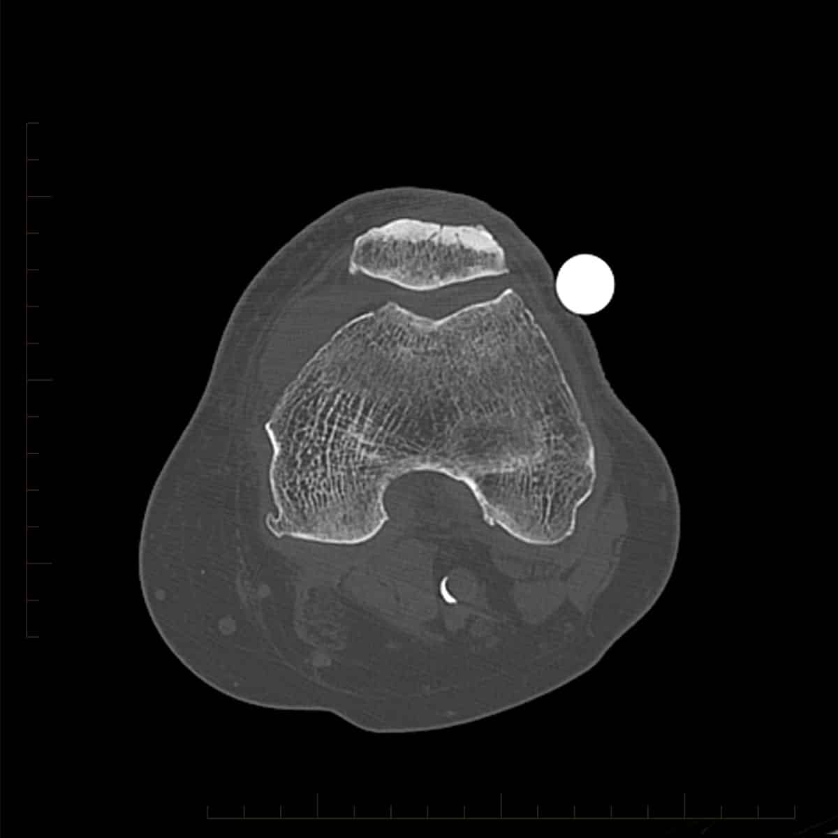 CT scan of a knee with metal reduction