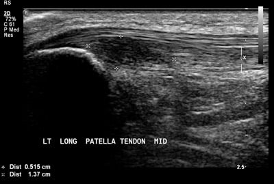 1. Ultrasound of the left patellar tendon demonstrates and area of decreased echotexture (dark area bordered by calipers) consistent with a large tear of the deep surface of the patellar tendon, commonly known as “Jumper’s knee”.