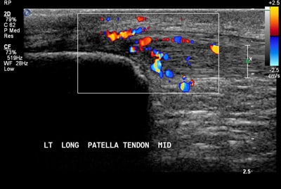 2. Colour flow demonstrates increased blood flow to the damaged tendon.
