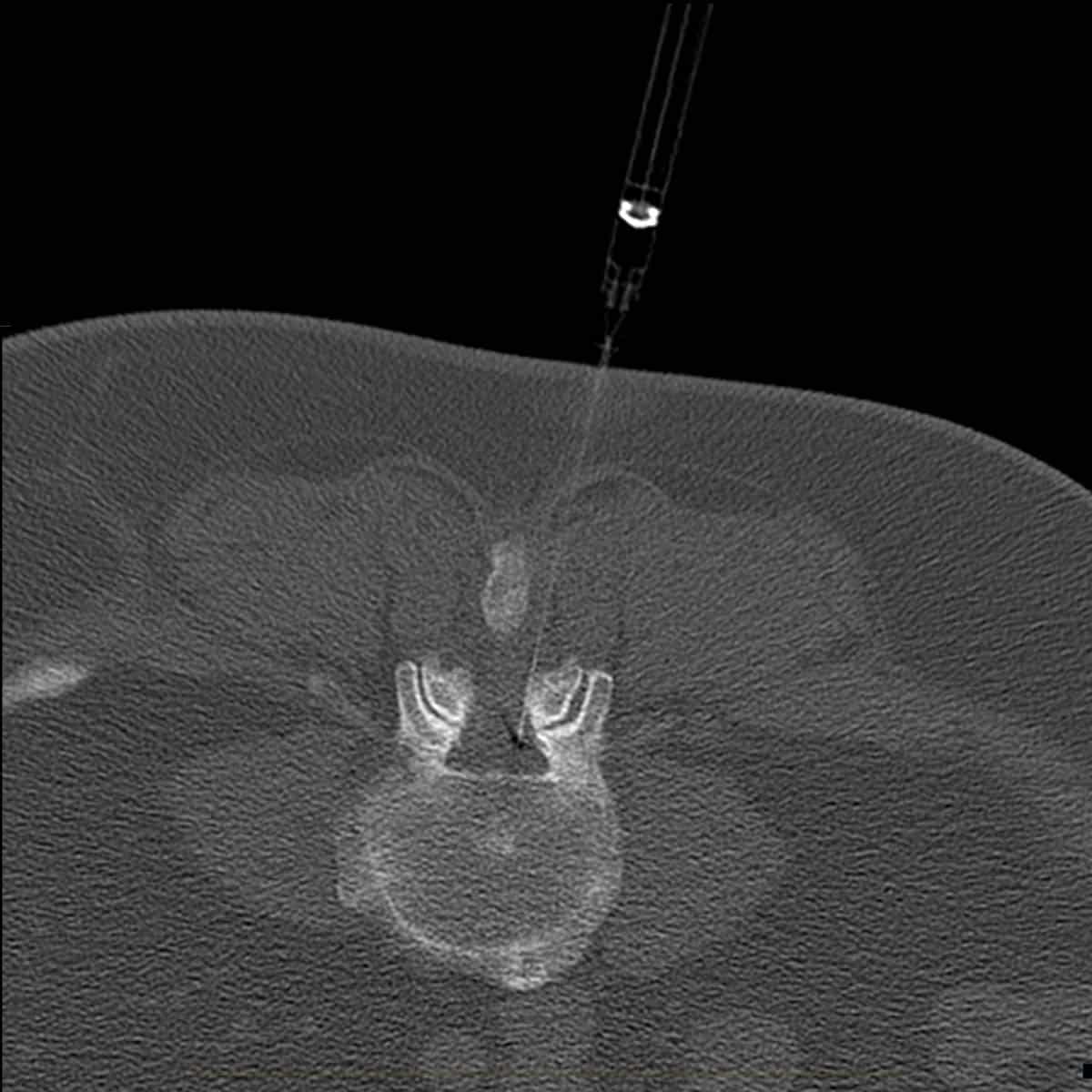 CT scan of a lumbar epidural injection