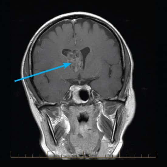 MRI scan of the head
