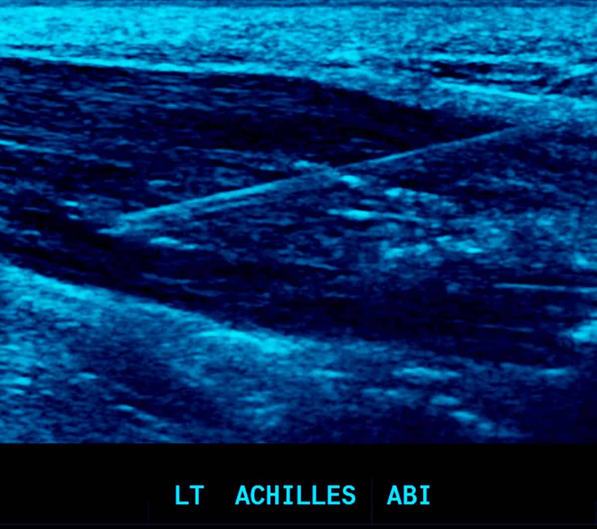 Direct Tendon Injections - Achilles ABI