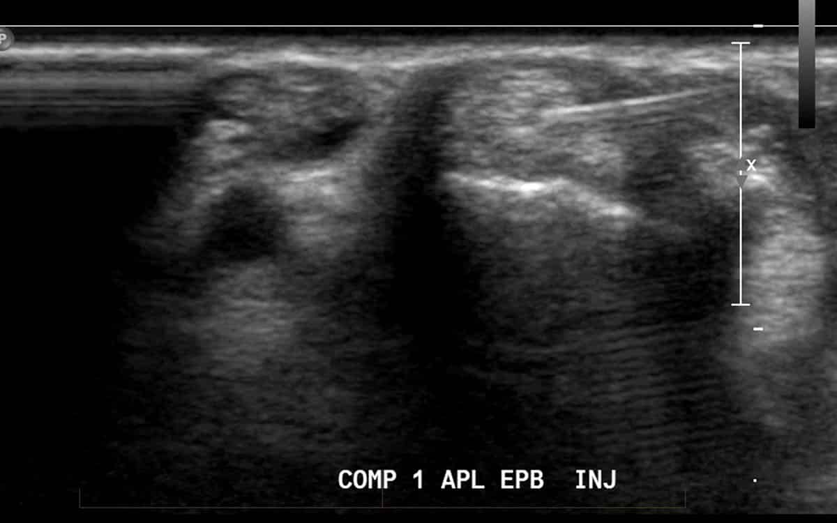 Ultrasound guided injection treat de Quervain’s tenosynovitis