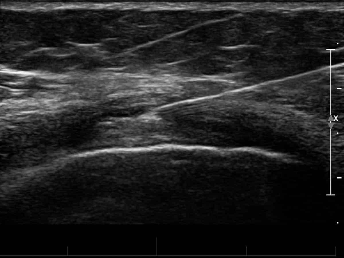 ultrasound guided injection of a knee
